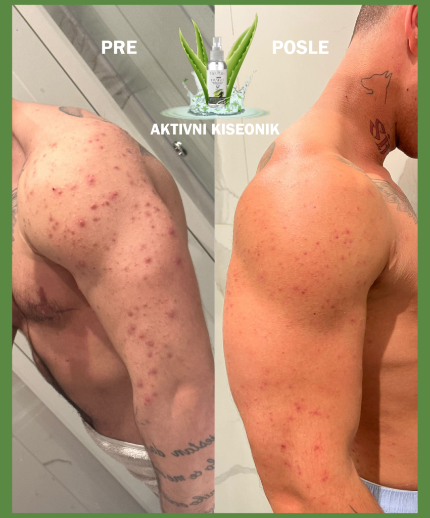 pre i posle korišćenja aktivnog kiseonika na telu