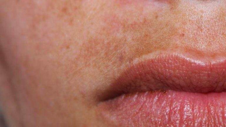 Fleke na koži – Zašto se pojavljuju i kako ih se rešiti