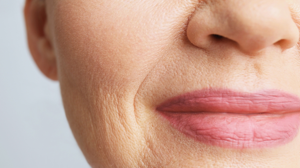 Marionetske bore oko usana na licu žene