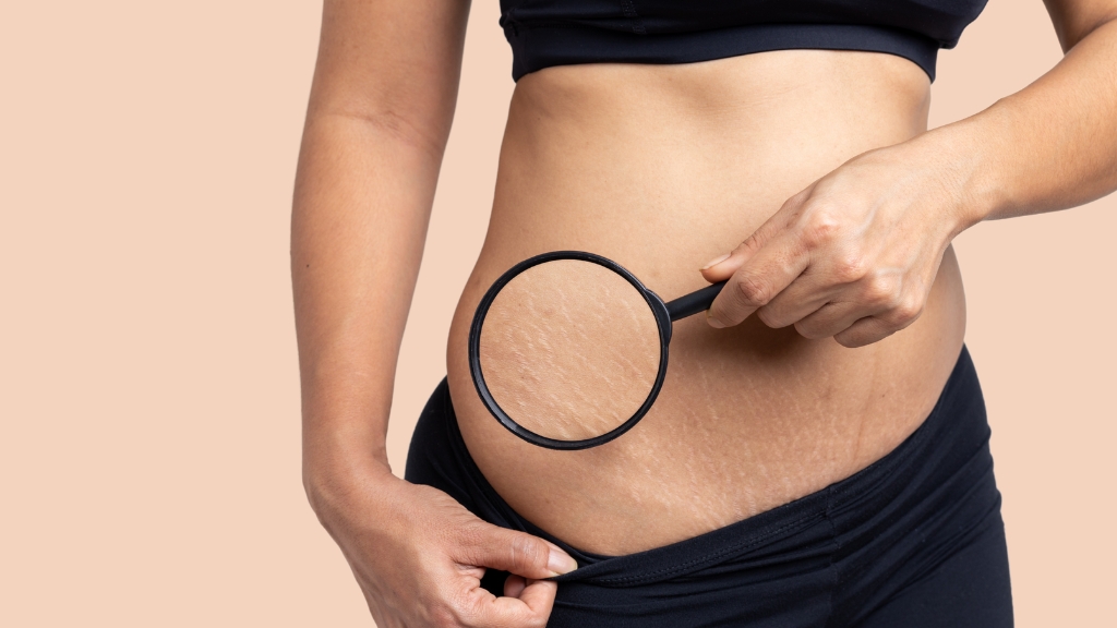 Žena pokazuje strije na stomaku pomoću lupe