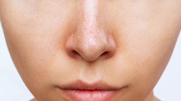 Mitiseri na nosu izbliza