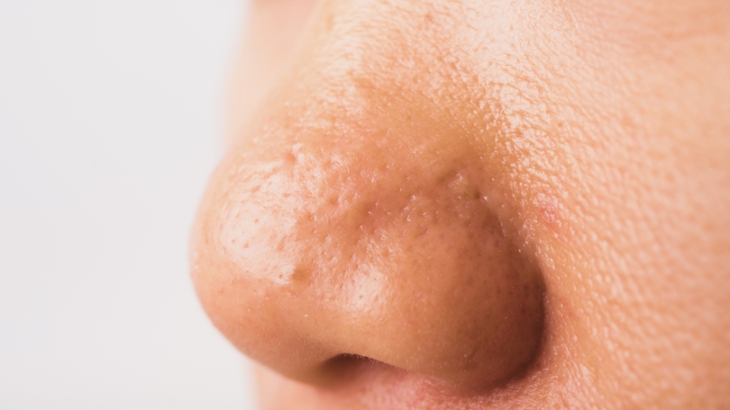 Komedoni na nosu izbliza