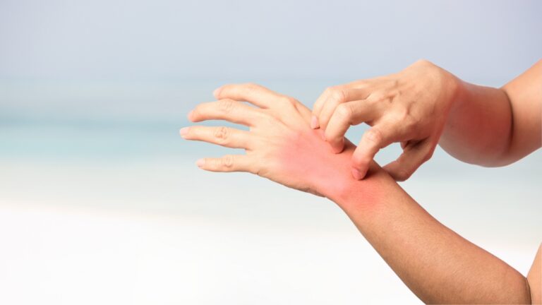 Osip i crvenilo na ruci nakon izlaganja suncu, osoba češe kožu zbog jakog svraba