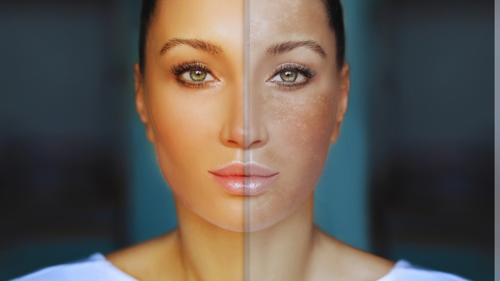 Lice žene podeljeno na dva dela – levo prikazuje ujednačen, zdrav ten, dok desno otkriva tamne fleke i promene tipične za hiperpigmentaciju