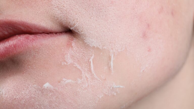 Zašto mislim da je perutanje kože lica znak da vaša rutina ne funkcioniše